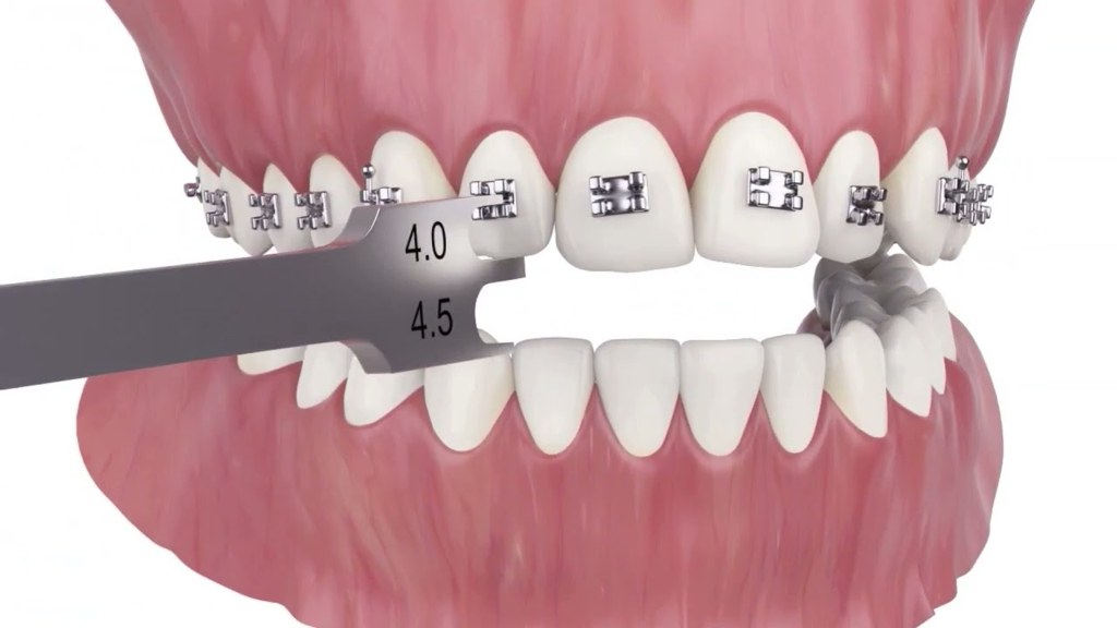 Video: how Dr. Woods places braces precisely with DIBS digital planning